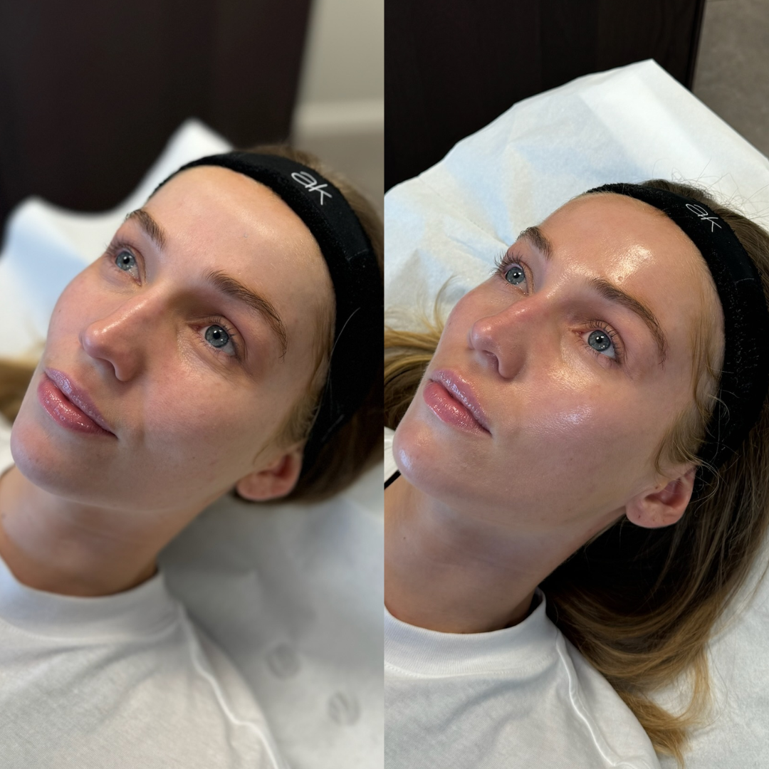 før og etter hydrafacial